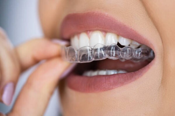 What to Do if Your Invisalign Tray Breaks or Cracks