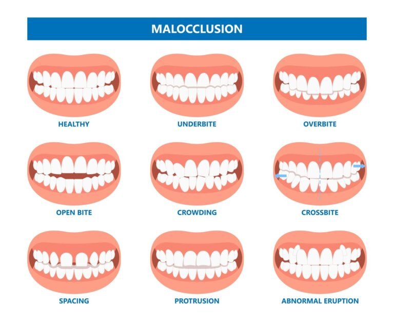 Can Invisalign Correct Overbites, Underbites, and Crossbites?
